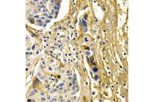 Immunohistochemistry of paraffin-embedded human liver cancer using CFH antibody. (Complement Factor H 抗体)