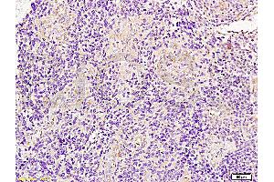 Formalin-fixed and paraffin embedded human glioma tissue labeled with Anti-JUP/Cateninma ? (JUP 抗体  (AA 601-700))