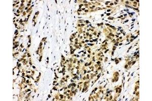 IHC-P: MCM7 antibody testing of human lung cancer tissue (MCM7 抗体  (C-Term))