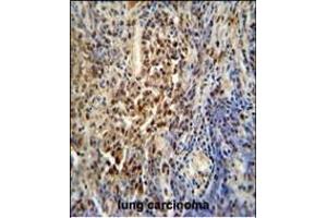 PUS3 antibody (N-term) (ABIN654789 and ABIN2844467) immunohistochemistry analysis in formalin fixed and paraffin embedded human lung carcinoma followed by peroxidase conjugation of the secondary antibody and DAB staining. (PUS3 抗体  (N-Term))