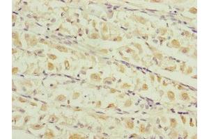 Immunohistochemistry of paraffin-embedded human gastric cancer using ABIN7159903 at dilution of 1:100 (TIMM17B 抗体  (AA 1-172))