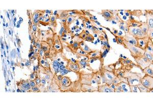 Immunohistochemistry of paraffin-embedded Human cervical cancer using Claudin 1 Polyclonal Antibody at dilution of 1:150 (Claudin 1 抗体)