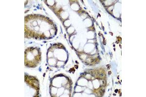 Immunohistochemistry of paraffin-embedded human colon carcinoma using SECISBP2 antibody at dilution of 1:200 (40x lens). (SECISBP2 抗体)