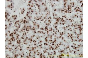 Immunoperoxidase of monoclonal antibody to HMGB1 on formalin-fixed paraffin-embedded human hepatocellular carcinoma tissue. (HMGB1 抗体  (AA 1-215))