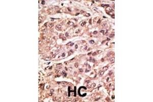 Formalin-fixed and paraffin-embedded human cancer tissue reacted with the primary antibody, which was peroxidase-conjugated to the secondary antibody, followed by DAB staining. (SUMO4 抗体  (Mutant, Val55))
