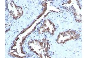 Immunohistochemical staining (Formalin-fixed paraffin-embedded sections) of human prostate carcinoma with CCNB1 monoclonal antibody, clone CCNB1/1098 .