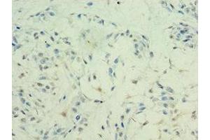 Immunohistochemistry of paraffin-embedded human breast cancer using ABIN7155309 at dilution of 1:100 (HDAC11 抗体  (AA 1-347))