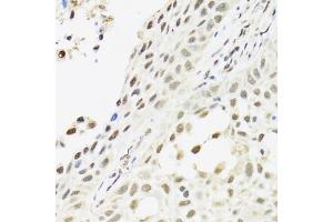 Immunohistochemistry of paraffin-embedded human lung cancer using C14orf166 antibody. (C14orf166 抗体)