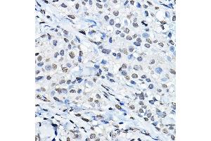 Immunohistochemistry of paraffin-embedded human breast cancer using MonoMethyl-Histone H3-K27 Rabbit pAb (ABIN3023262, ABIN3023263, ABIN3023264, ABIN1513004 and ABIN6219518) at dilution of 1:100 (40x lens).