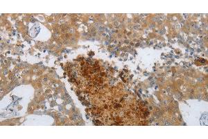 Immunohistochemistry of paraffin-embedded Human breast cancer using NGFR Polyclonal Antibody at dilution of 1:50 (NGFR 抗体)