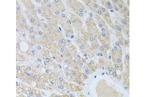 Immunohistochemistry of paraffin-embedded Human liver damage using DLK1 Polyclonal Antibody at dilution of 1:100 (40x lens). (DLK1 抗体)