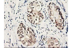 Immunohistochemical staining of paraffin-embedded Adenocarcinoma of Human breast tissue using anti-PSMB4 mouse monoclonal antibody. (PSMB4 抗体)