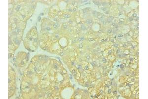 Immunohistochemical of paraffin-embedded human liver cancer using ABIN7143609 at dilution of 1:200 (Fetuin A 抗体)
