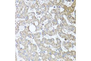 Immunohistochemistry of paraffin-embedded human liver injury using TSG101 antibody. (TSG101 抗体)