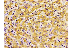 Immunohistochemistry of paraffin-embedded human liver cancer using ABIN7172602 at dilution of 1:100 (SOX11 抗体  (AA 241-341))