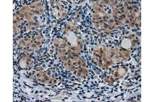 Immunohistochemical staining of paraffin-embedded Adenocarcinoma of colon tissue using anti-PTPRE mouse monoclonal antibody. (PTPRE 抗体)