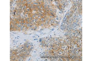 Immunohistochemistry of Human esophagus cancer using NDRG1 Polyclonal Antibody at dilution of 1:70 (NDRG1 抗体)