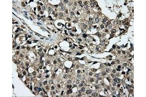 Immunohistochemical staining of paraffin-embedded prostate tissue using anti-DCXRmouse monoclonal antibody. (DCXR 抗体)