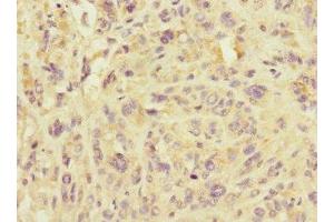 Immunohistochemistry of paraffin-embedded human melanoma using ABIN7159921 at dilution of 1:100 (IMMP2L 抗体  (AA 1-100))