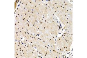 Immunohistochemistry of paraffin-embedded human gastric cancer using IRF2 antibody (ABIN3023366, ABIN3023367, ABIN3023368 and ABIN6219659) at dilution of 1:200 (40x lens). (IRF2 抗体  (AA 120-349))