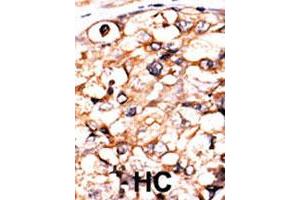 Formalin-fixed and paraffin-embedded human hepatocellular carcinoma tissue reacted with PGK2 polyclonal antibody  , which was peroxidase-conjugated to the secondary antibody, followed by AEC staining. (PGK2 抗体  (N-Term))