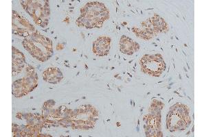 ABIN6268905 at 1/50 staining human breast cancer tissue sections by IHC-P. (OCT4 抗体  (Internal Region))