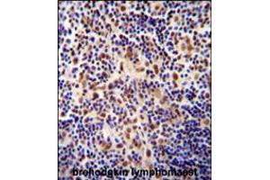 TIGD3 antibody immunohistochemistry analysis in formalin fixed and paraffin embedded human hodgkin lymphoma followed by peroxidase conjugation of the secondary antibody and DAB staining. (TIGD3 抗体  (C-Term))