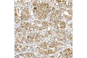 Immunohistochemistry of paraffin-embedded human liver cancer using S Rabbit mAb (ABIN7270501) at dilution of 1:250 (40x lens). (SAMM50 抗体)