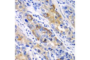 Immunohistochemistry of paraffin-embedded human gastric cancer using BCL2 antibody. (Bcl-2 抗体)