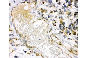 IHC-P: HO-1 antibody testing of human lung cancer tissue