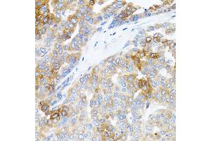 Immunohistochemistry of paraffin-embedded human liver cancer using STAT3 antibody (ABIN1876697) at dilution of 1:100 (40x lens). (STAT3 抗体)