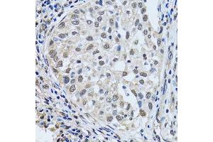 Immunohistochemistry of paraffin-embedded human lung cancer using LSM4 antibody. (LSM4 抗体  (AA 1-139))