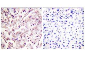 Immunohistochemical analysis of paraffin-embedded human breast carcinoma tissue, using ETS1 (Phospho-Thr38) antibody (left)or the same antibody preincubated with blocking peptide (right). (ETS1 抗体  (pThr38))