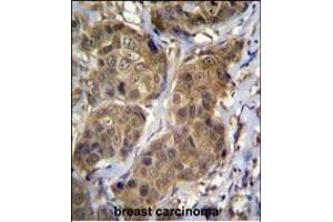 RNF11 Antibody (Center) (ABIN656832 and ABIN2846041) immunohistochemistry analysis in formalin fixed and paraffin embedded human breast carcinoma followed by peroxidase conjugation of the secondary antibody and DAB staining. (RNF11 抗体  (AA 64-90))