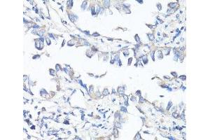 Immunohistochemistry of paraffin-embedded Human lung cancer using P Glycoprotein Polyclonal Antibody at dilution of 1:100 (40x lens). (P-Glycoprotein 抗体)