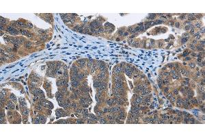 Immunohistochemistry of paraffin-embedded Human ovarian cancer tissue using SYT3 Polyclonal Antibody at dilution 1:40 (Synaptotagmin 3 抗体)