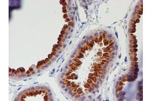 Immunohistochemical staining of paraffin-embedded Human breast tissue using anti-MEF2C mouse monoclonal antibody. (MEF2C 抗体)