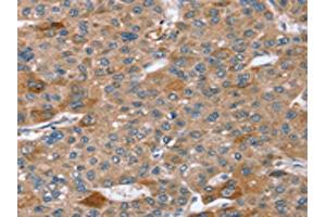 The image on the left is immunohistochemistry of paraffin-embedded Human liver cancer tissue using ABIN7192629(SPATA5L1 Antibody) at dilution 1/20, on the right is treated with synthetic peptide. (SPATA5L1 抗体)