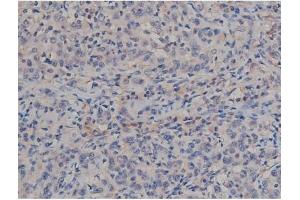 ABIN6267357 at 1/200 staining Human ganstric cancer tissue sections by IHC-P. (MAPT 抗体  (pSer422))