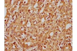 IHC image of ABIN7127584 diluted at 1:185 and staining in paraffin-embedded human liver cancer performed on a Leica BondTM system. (Recombinant ITGB1 抗体)