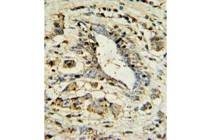 OL1 Antibody 7361a IHC analysis in formalin fixed and paraffin embedded human breast carcinoma followed by peroxidase conjugation of the secondary antibody and DAB staining. (APOL1 抗体  (AA 137-171))