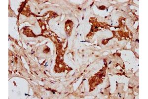 IHC image of ABIN7148040 diluted at 1:300 and staining in paraffin-embedded human breast cancer performed on a Leica BondTM system. (Codanin 1 (CDNA1) (AA 62-249) 抗体)