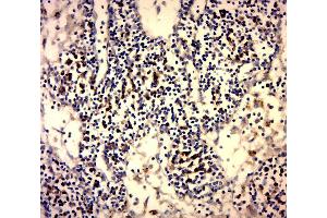 Paraformaldehyde-fixed, paraffin embedded Human Cervical Cancer, Antigen retrieval by boiling in sodium citrate buffer (pH6. (Galectin 3 抗体  (AA 151-250))
