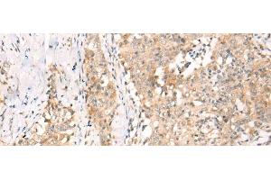 Immunohistochemistry of paraffin-embedded Human esophagus cancer tissue using YRDC Polyclonal Antibody at dilution of 1:30(x200) (YRDC 抗体)