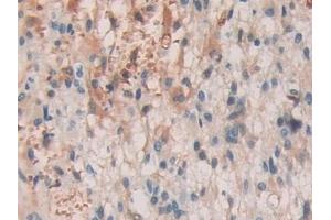 Detection of SHC3 in Human Glioma Tissue using Polyclonal Antibody to SHC-Transforming Protein 3 (SHC3) (SHC3 抗体  (AA 188-433))