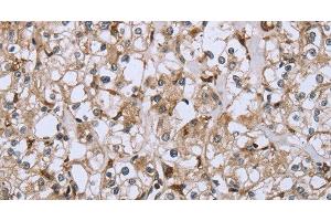 Immunohistochemistry of paraffin-embedded Human prostate cancer using CD32 Polyclonal Antibody at dilution of 1:40 (Fc gamma RII (CD32) 抗体)