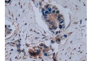 Detection of C2CD3 in Human Breast cancer Tissue using Polyclonal Antibody to C2 Calcium Dependent Domain Containing Protein 3 (C2CD3) (C2CD3 抗体  (AA 1432-1647))