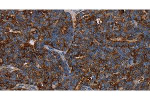 Immunohistochemistry of paraffin-embedded Human ovarian cancer using HMGCL Polyclonal Antibody at dilution of 1:30 (HMGCL 抗体)