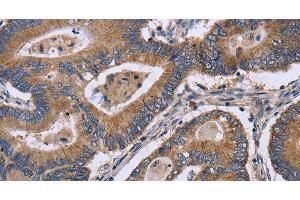 Immunohistochemistry of paraffin-embedded Human colon cancer using GABPB2 Polyclonal Antibody at dilution of 1:30 (GABPB2 抗体)