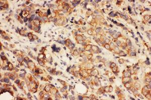 Anti-HDAC2 antibody,  IHC(P) IHC(P): Human Mammary Cancer Tissue (HDAC2 抗体  (C-Term))
